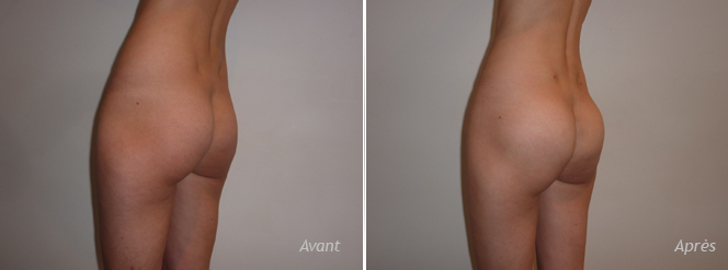 La croissance vertigineuse de l’implant fessier