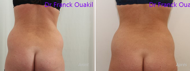 La “lipo” sans contrainte: La cryolipolyse ca marche !!