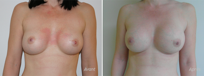 Lipofilling secondaire des seins