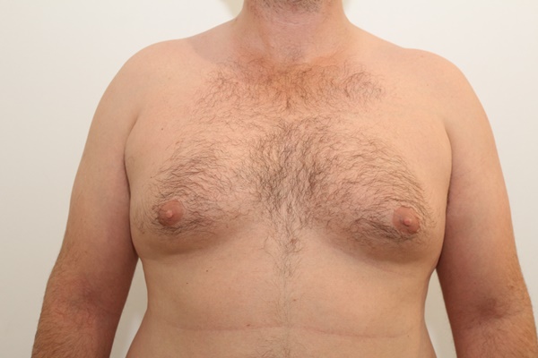 La Cryolipolyse : la première alternative à la liposuccion